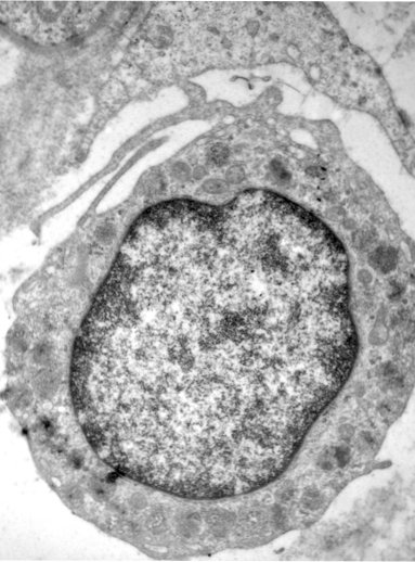 Imagine de microscopie electronică a biopsiei cutanate, înainte de tratament.